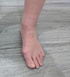 Person in Albany Creek with foot pain from bunion