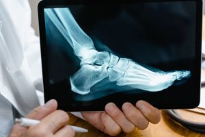 x ray of foot with bunion